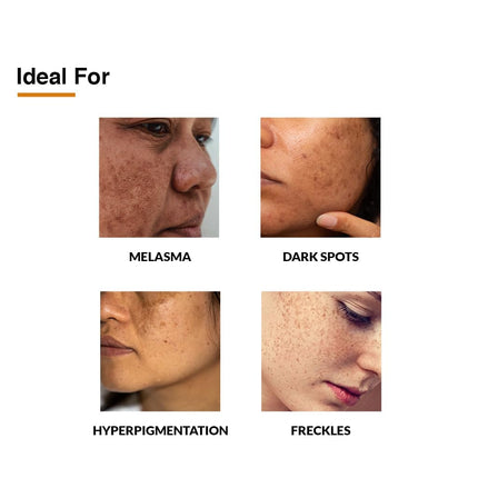 Fixderma 2% Kojic Acid + 1% Arbutin Skarfix-Plus Scar Removal Cream -15 g