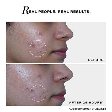 Novology Acne Spot Corrector Gel-30g