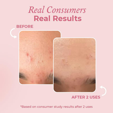 The Pink Foundry Acne Spot Corrector with Salicylic Acid & Sulfur-15ml