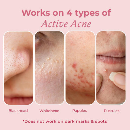 The Pink Foundry Acne Spot Corrector with Salicylic Acid & Sulfur-15ml