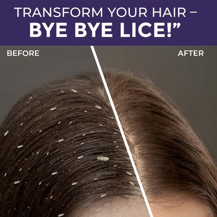 Sanfe anti lice & dandruff shampoo with tea tree oil & eucalyptus