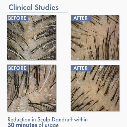 ThriveCo Anti-Dandruff Pre-Shampoo Serum- 10ml