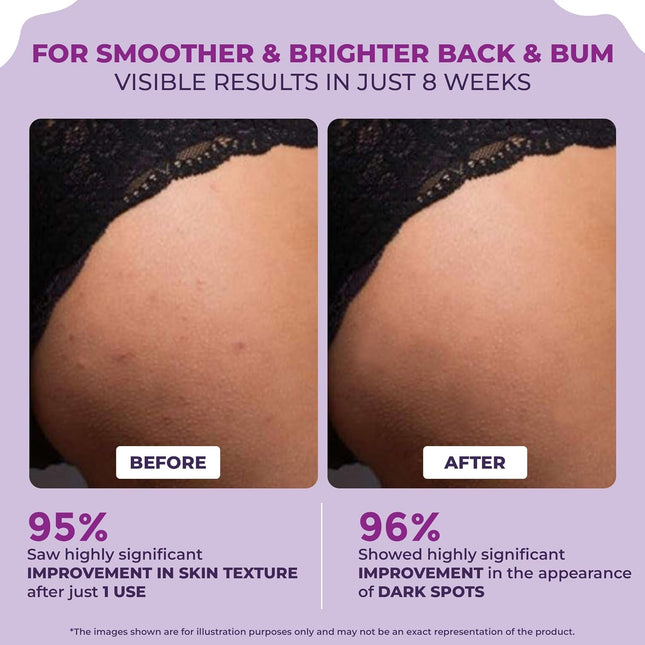 Sanfe Back & Bum Cream for Dark Spots and Body Acne | Glycolic Acid, Lactic Acid & Urea | 11% AHA-100gm