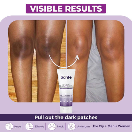 Sanfe Instant Spotlite Mask For Dark Underrams, Neck & Body-100g