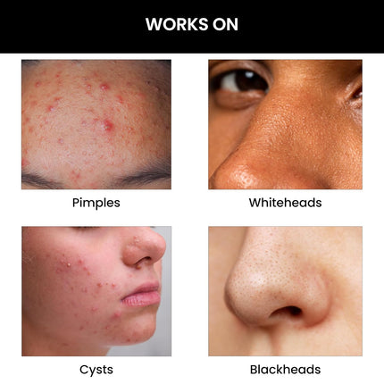 ThriveCo Goodbye Acne Face Wash -100ml