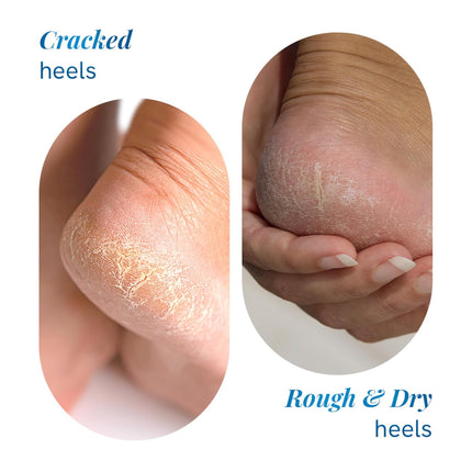 Be Bodywise 20% Urea Foot Cream Roll On | With 2% Lactic Acid, Olive Oil & Vitamin E