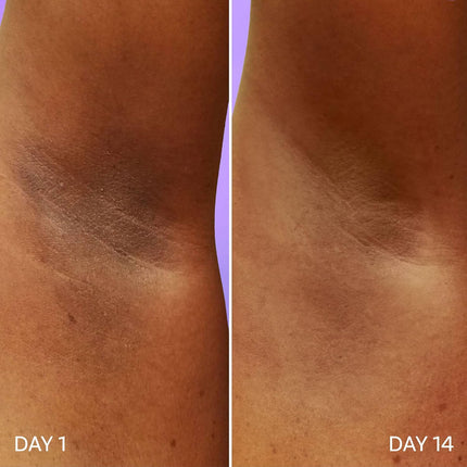 Bombae Underarm Roll on Deodorant 1% Salicylic Acid, 2% Glycolic Acid, 2% Lactic Acid| 5% AHA+BHA