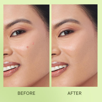 Quench Zit Away Acne Pimple Patches for Face - 24 Patches